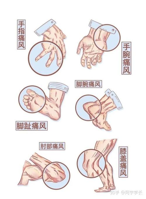 痛风消肿了还是有点痛