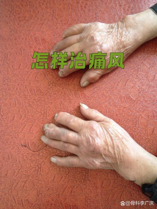 痛风老反复发作是晚期