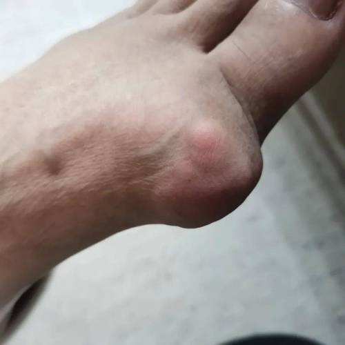 痛风老反复发作是晚期