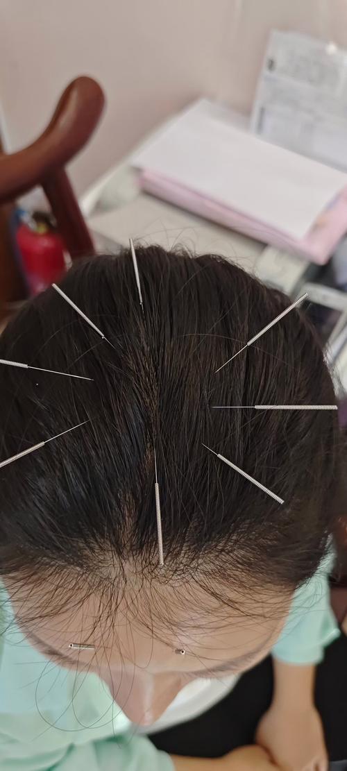 脑血管堵塞可以针灸吗