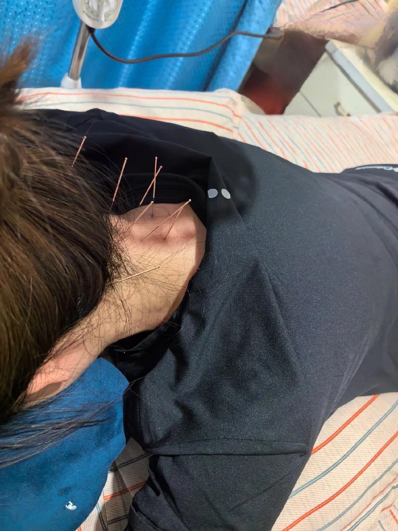 脑血管堵塞可以针灸吗