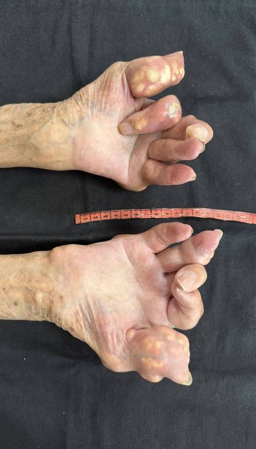 神经性痛风的症状表现