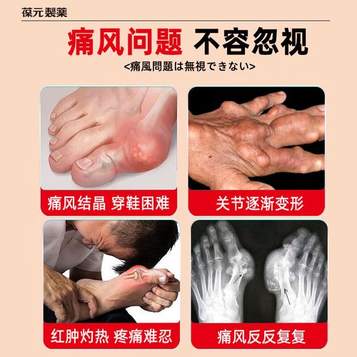 痛风部位可以贴膏药吗