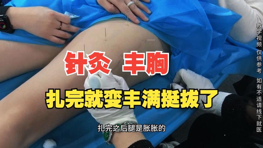 哪里可以做针灸丰胸的