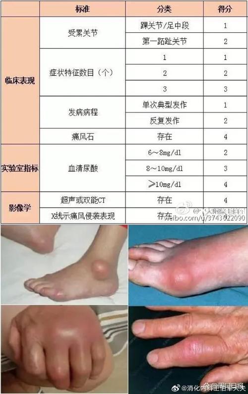 痛风在部队可以评残吗