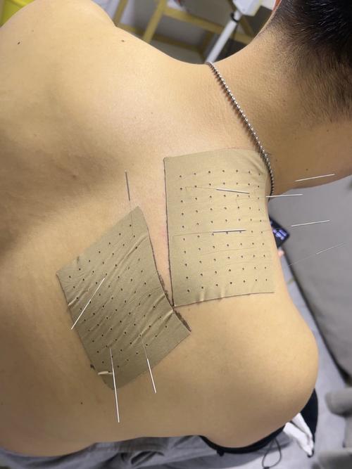 外科病症针灸治疗实践