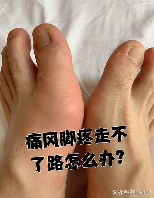 痛风晚上脚要盖被子吗