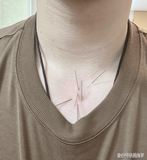 中医针灸治疗慢性咽炎