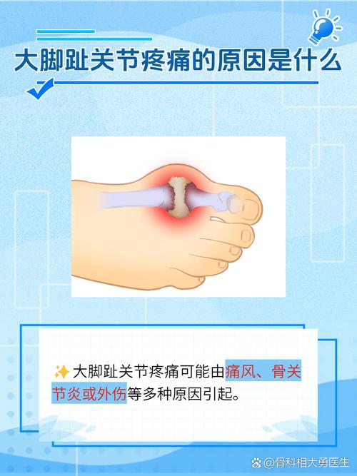 大脚趾疼是痛风初期吗