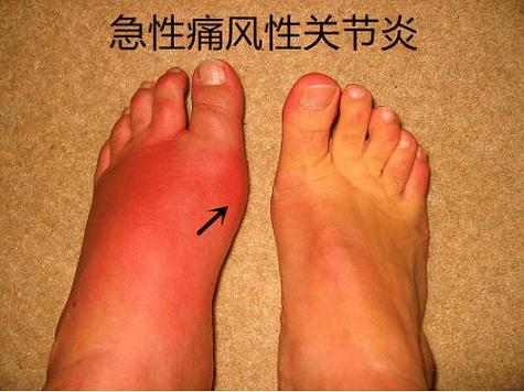 广州看痛风哪间医院好