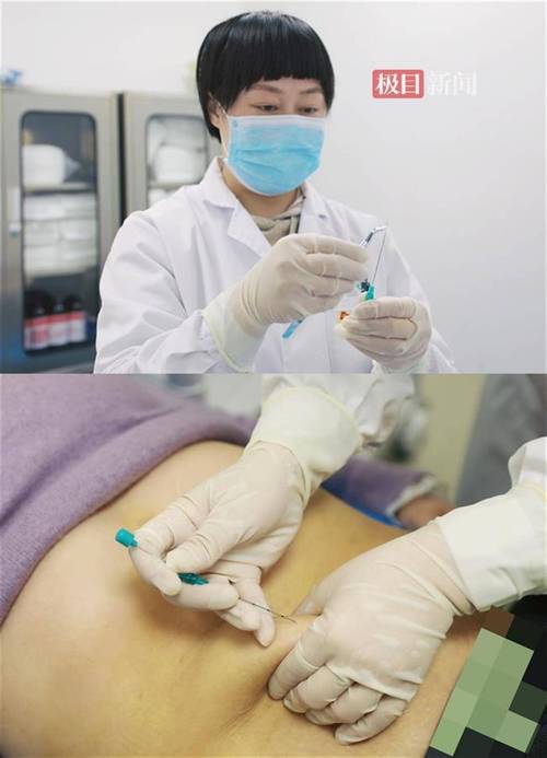 深圳北大医院针灸减肥