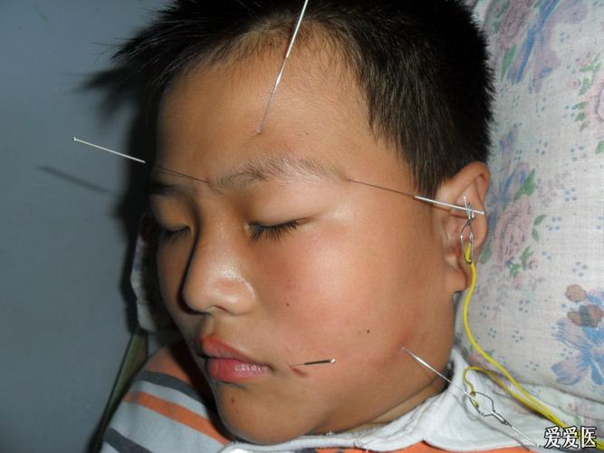 小儿面瘫针灸治疗视频