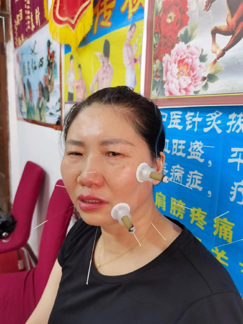 小儿面瘫针灸治疗视频