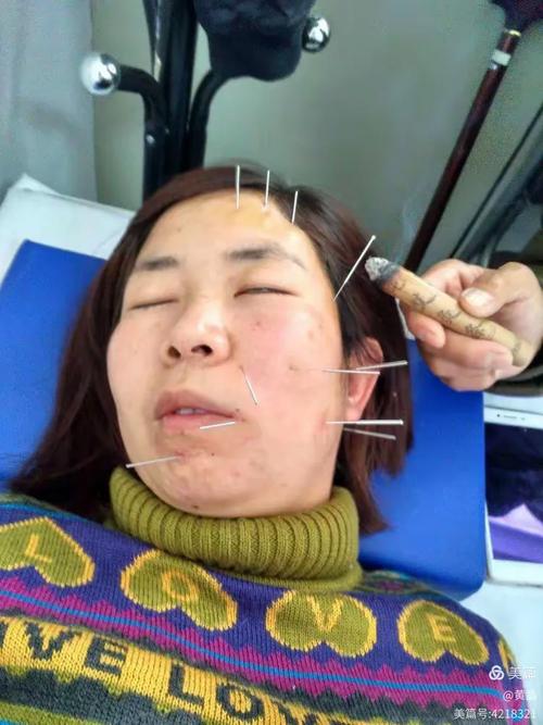 小儿面瘫针灸治疗视频