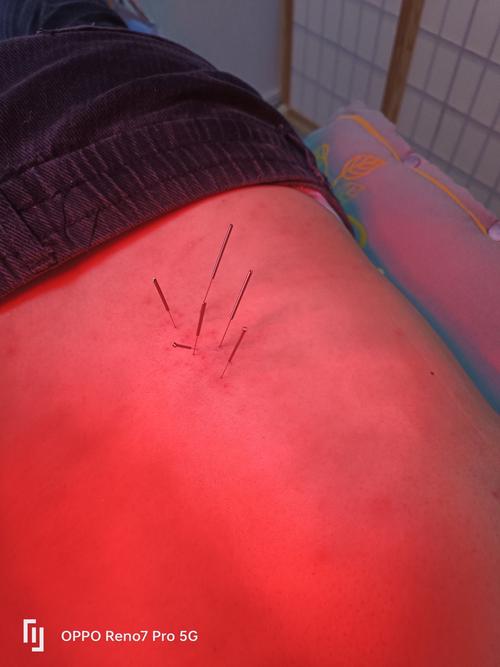 腰肌劳损针灸哪个部位