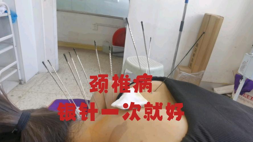 哪里可以打造针灸银针