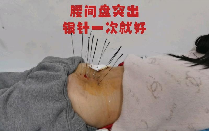 哪里可以打造针灸银针