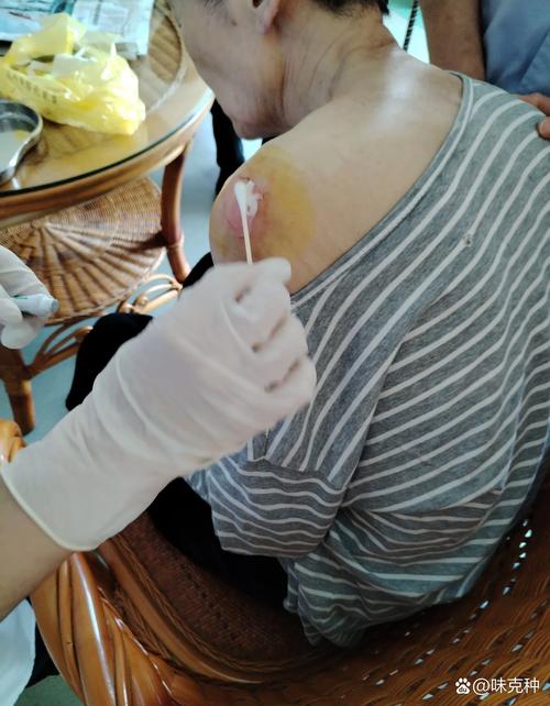 昆明工人医院针灸减肥