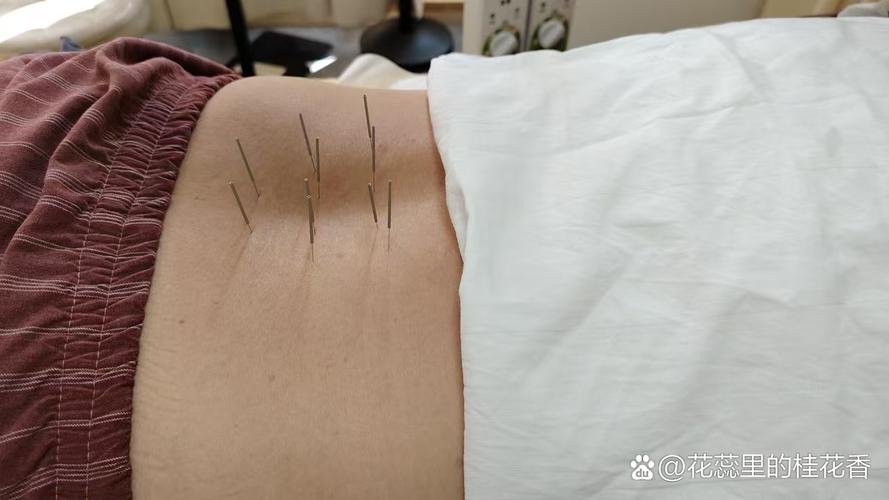 针灸甲状腺结节扎后背