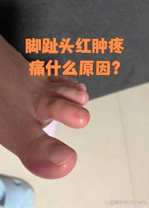 脚趾肿痛一定是痛风吗