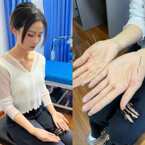 女人减肥针灸图片大全