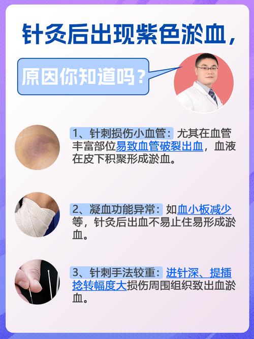 针灸血肿最佳处理方法