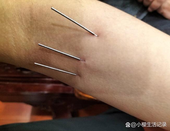 乳腺增生针灸哪些穴位