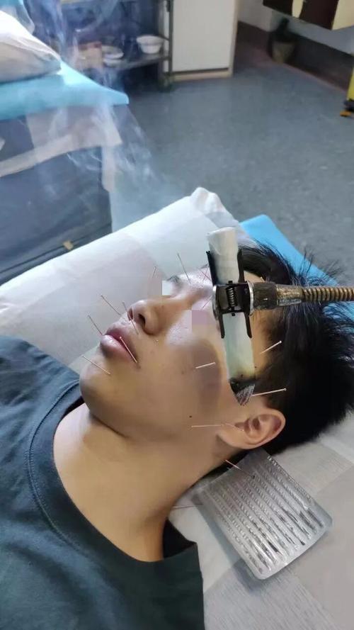 针灸电针治疗面瘫图片