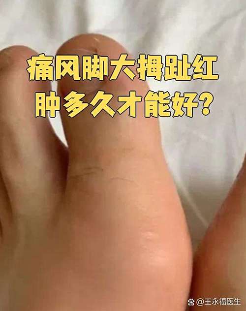 痛风发作大概多久能好