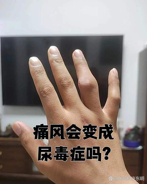 轻度痛风能自然疗法么