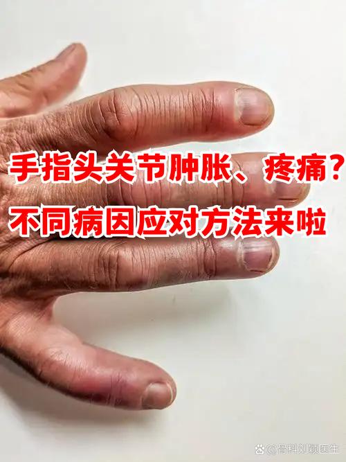 手指关节酸痛是痛风吗