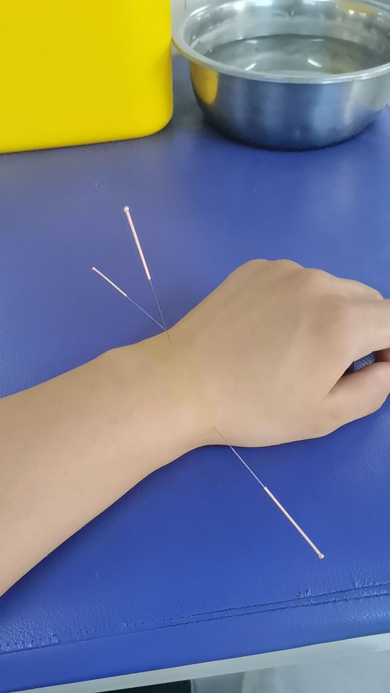 手腕扭伤针灸什么学位