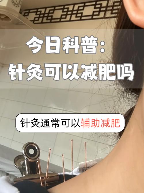 针灸减肥价位瘦身方法