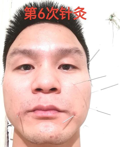 轻度面瘫针灸多久会好