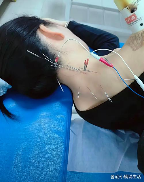 针灸治疗子宫肌瘤视频