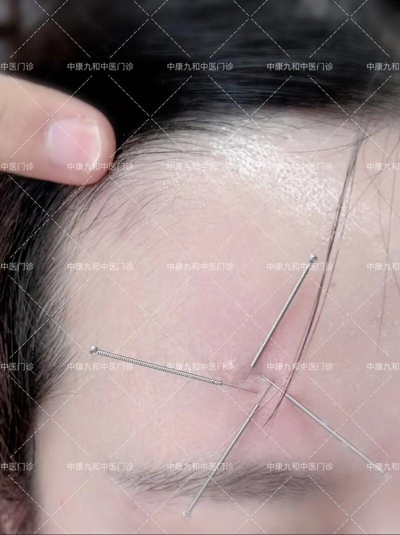 针灸治疗面瘫效果好吗