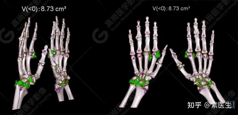 双源ct能确诊痛风吗