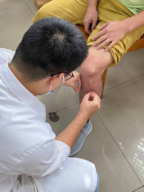 中医针灸治疗髌骨劳损