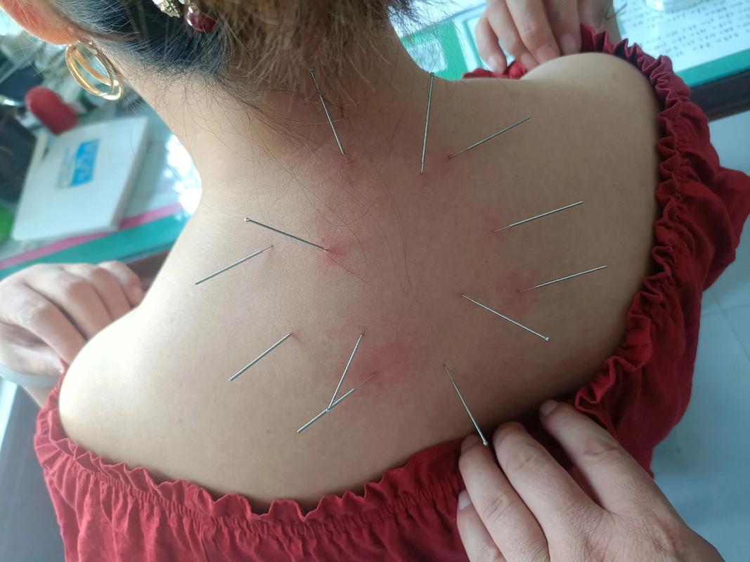 中医针灸治疗背部痤疮