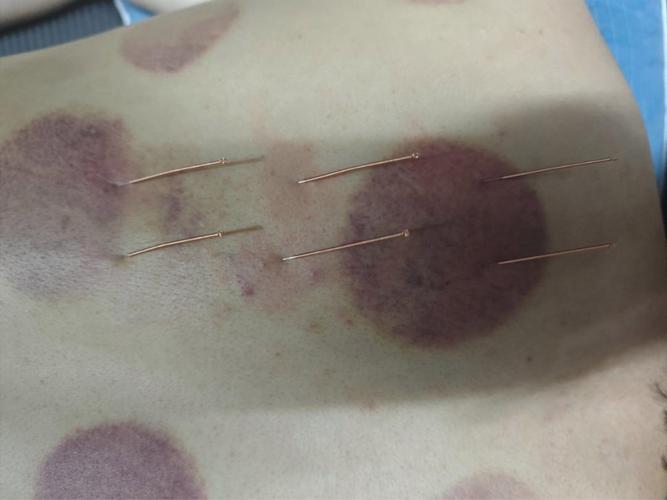 中医针灸治疗背部痤疮