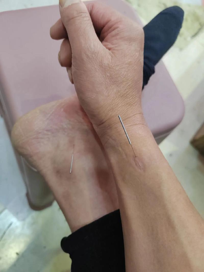 南昌哪里可以学习针灸