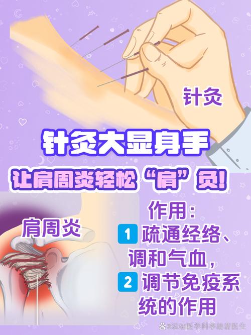 针灸治疗肩周炎ppt