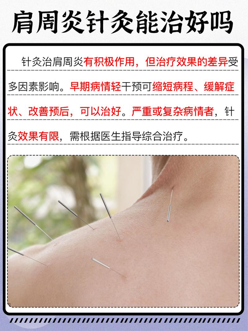 针灸治疗肩周炎ppt
