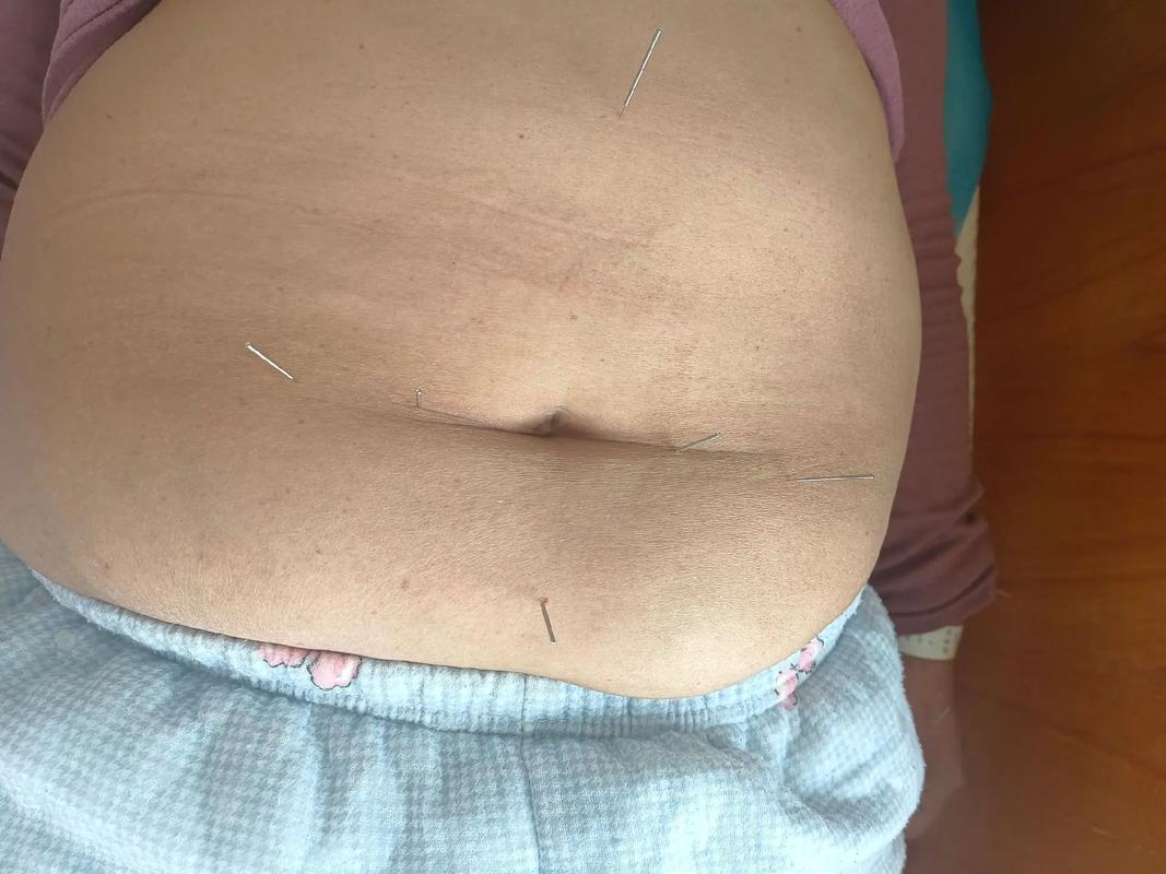 乌鲁木齐哪里可以针灸