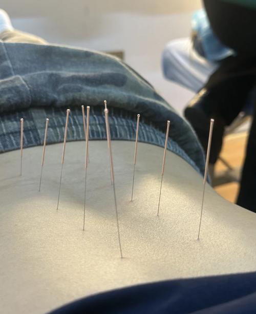 针灸腰间盘突出好不好