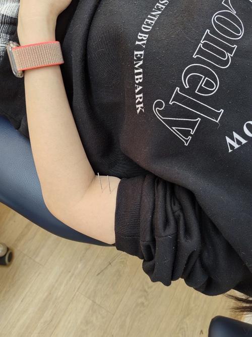 风湿性关节炎可以针灸