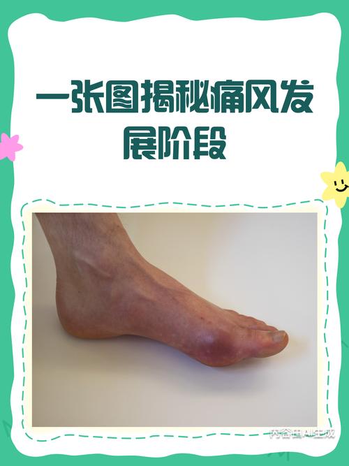 女人痛风会影响怀孕吗