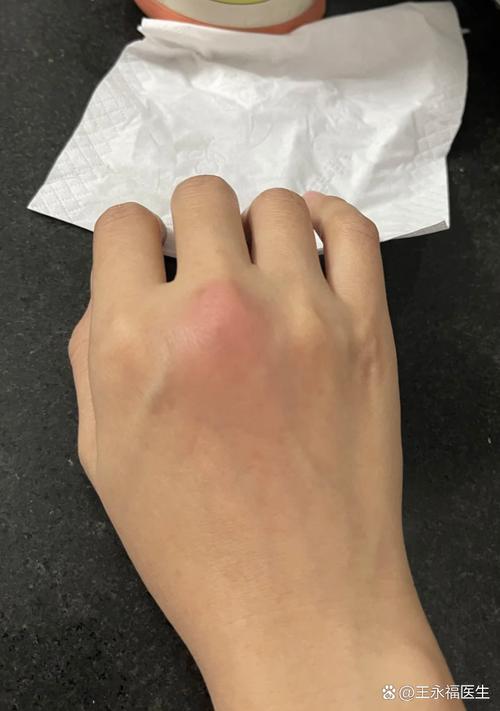 痛风初期是轻微疼痛吗