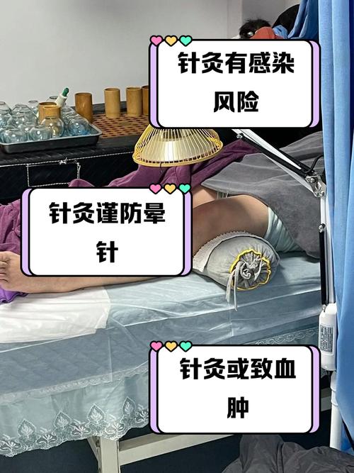 针灸治疗更年期综合症