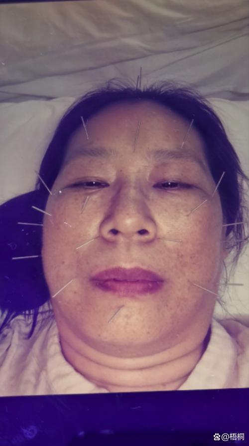 针灸治疗更年期综合症